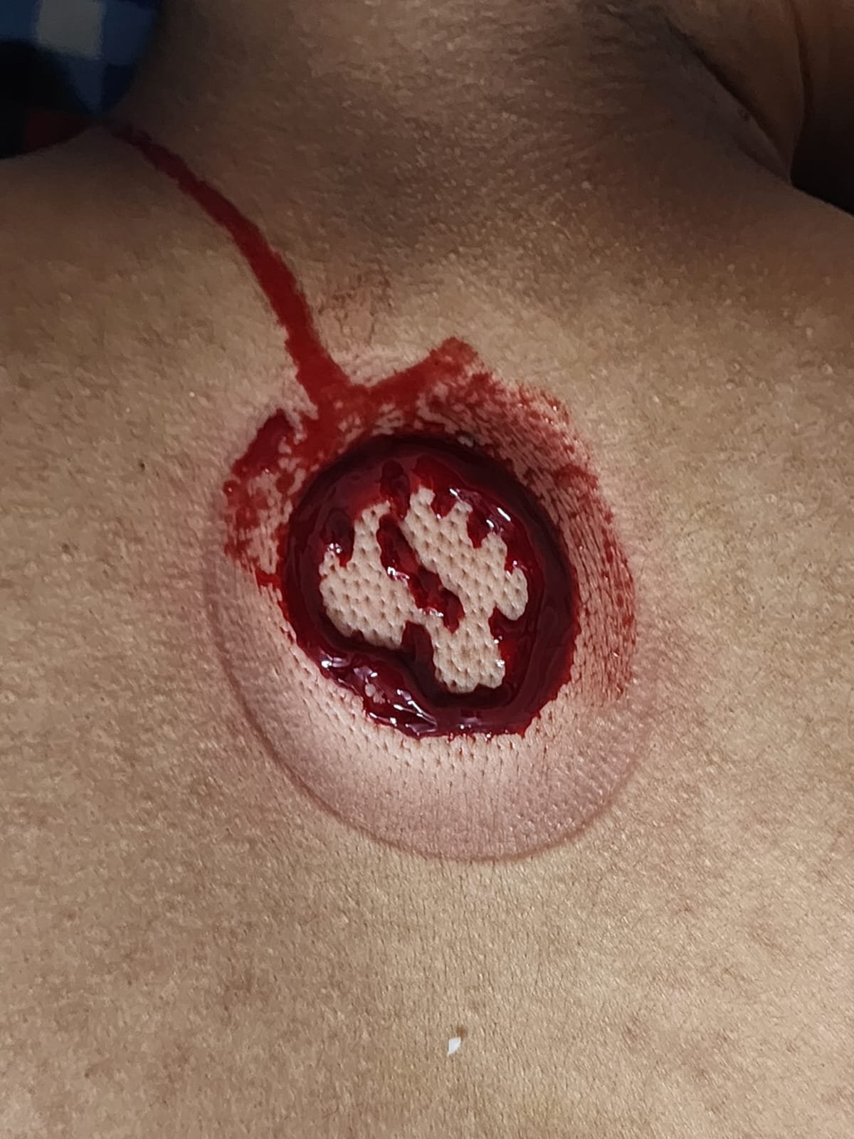 Lumbar Disc Herniation Relief Zone